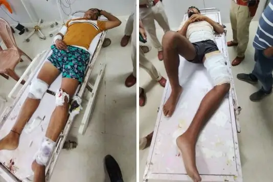 Police Encounter in Bihiya: गोली लगने से रविरंजन के जांध की हड्डी कर गई है फ्रैक्चर